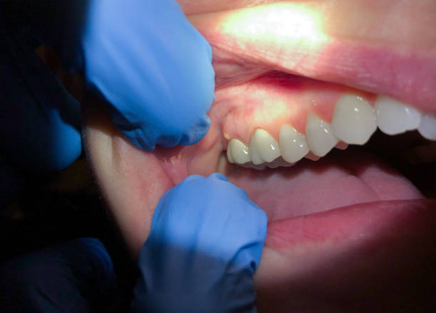 Best Emergency Treatment for Dental Infections or Abscesses in Sinking Spring, PA